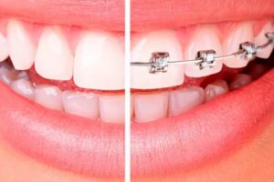 La ortodoncia tiene 7 pasos