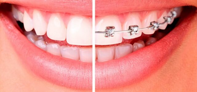 La ortodoncia tiene 7 pasos