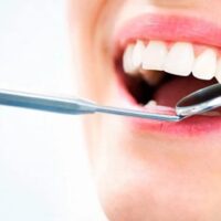 Manchas en el esmalte de los dientes