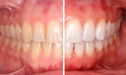 Como Se Hace Un Blanqueamiento Dental