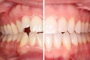 Resultado después de ortodoncia con brackets