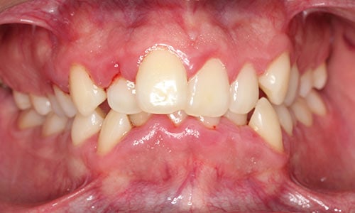 Apiñamiento dental: ¿cómo corregirlo? | Clínica Ferrus & Bratos