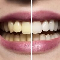 Blanqueamiento combinado: antes y después