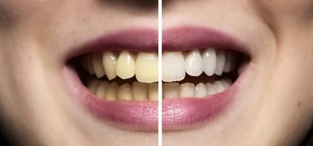 Blanqueamiento dental: antes y después Blanqueamiento combinado: antes y después