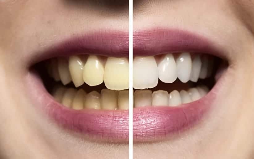 Blanqueamiento dental: antes y después Blanqueamiento combinado: antes y después