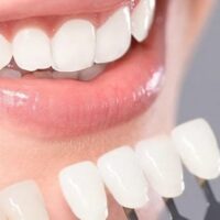Blanqueamiento dental combinado
