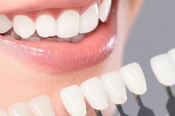 Blanqueamiento dental combinado