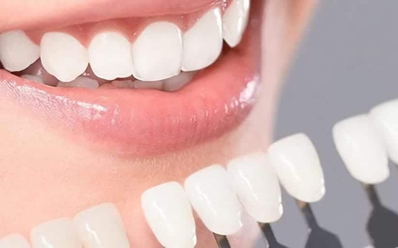 Blanqueamiento dental combinado