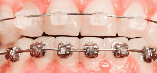 Brackets estéticos de zafiro (1) Brackets estéticos de zafiro