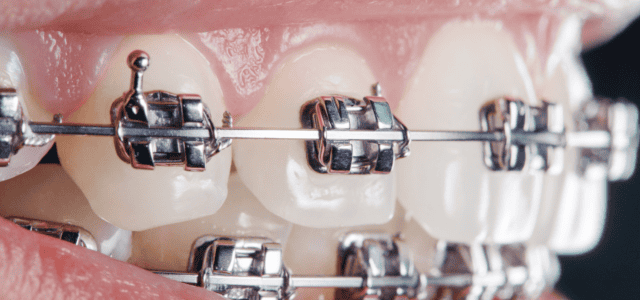 Brackets metálicos convencionales Brackets metálicos convencionales