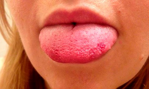 La lengua remedios para curar caseros en granitos