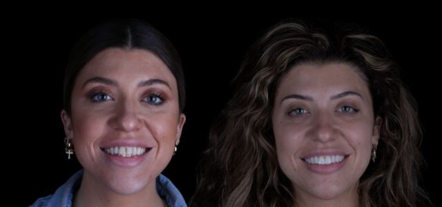 Como se pone una carilla dental