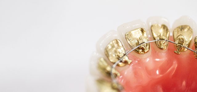 Experiencia con brackets linguales Incognito Clínica ortodoncia invisible en Madrid