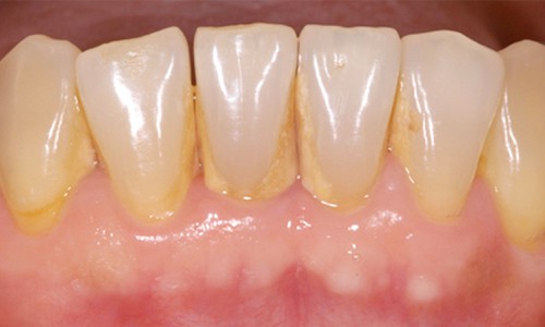 Como eliminar el calculo dental en casa