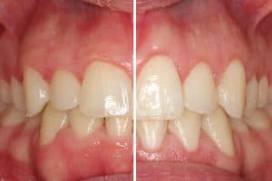 Recontorneado estético gingival: antes y después