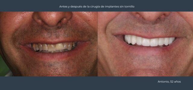 Implantes con poco hueso