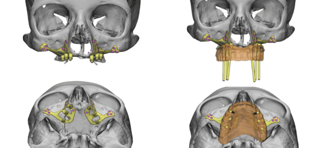 Planificación implantes sin tornillo