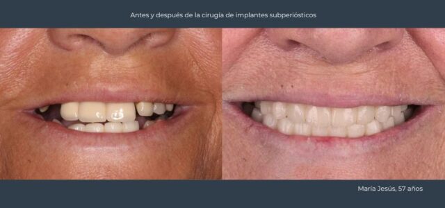 Resultado Implantes poco hueso