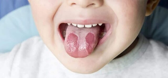 Lengua geográfica: causas y tratamiento Qué es la lengua geográfica y cómo se cura