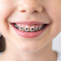 niña con brackets