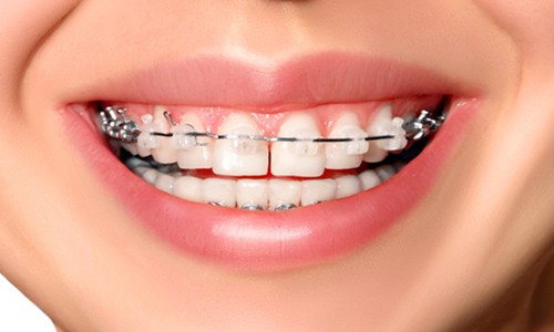 precio de ponerse brackets en ecuador