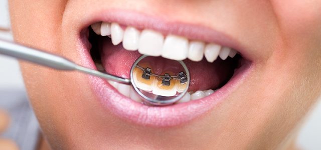 Preguntas frecuentes ortodoncia lingual Qué necesitas saber sobre los brackets Incognito