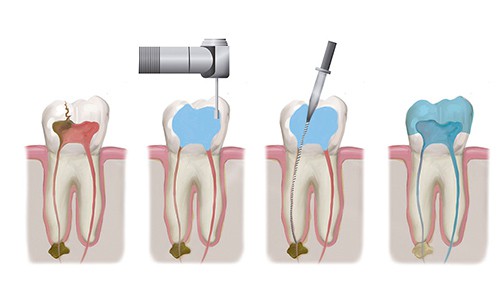 Endodoncia: último recurso para que no pierdas tus dientes