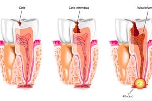 Remedios para la caries dental