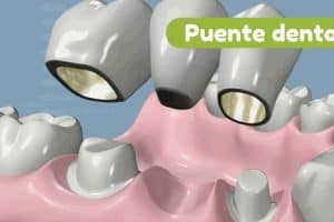 Puente dental