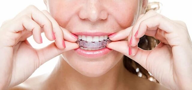 Qué puedes comer con Invisalign Restricciones en la alimentación en Madrid