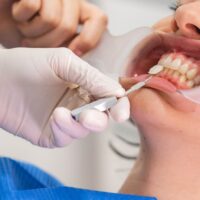 Requisitos para ponerse carillas dentales