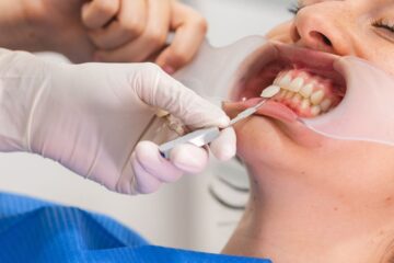 Requisitos para ponerse carillas dentales