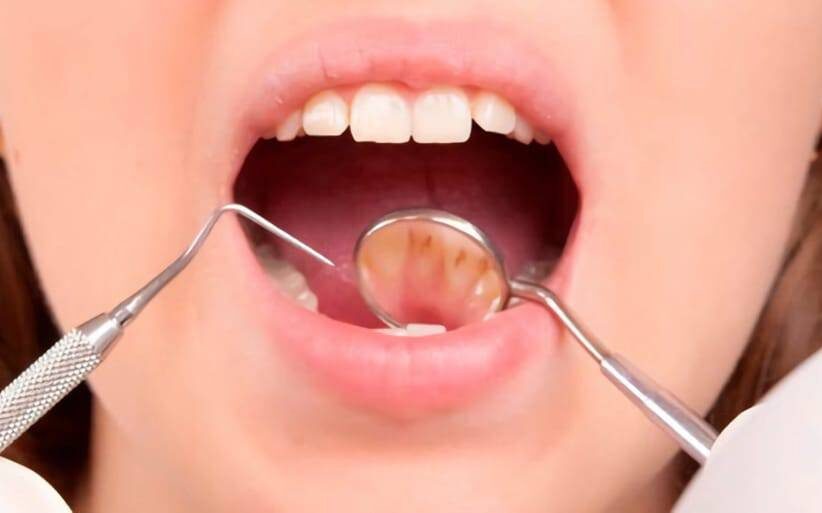 Cómo se forma el sarro dental