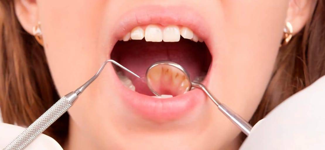 asentamiento radical muy agradable Sarro dental: ¿por qué se forma y cómo eliminarlo? | Ferrus&Bratos