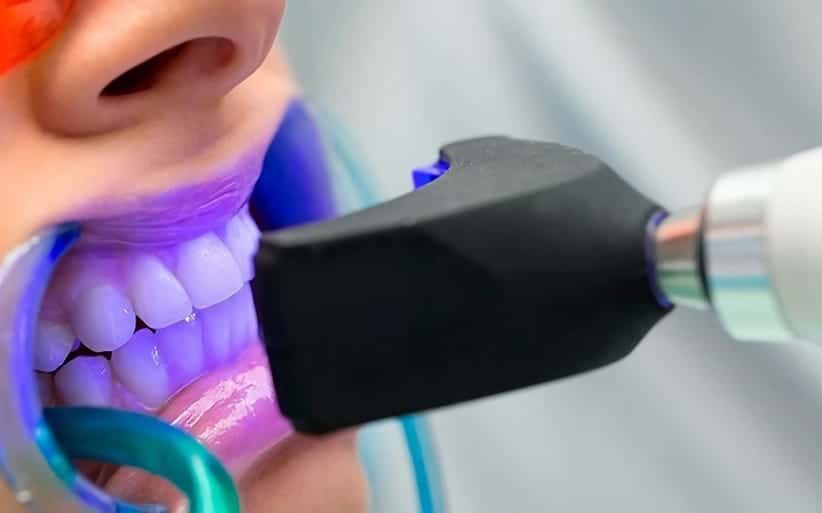 Tiempo-blanqueamiento-dental blanqueamiento con lampara