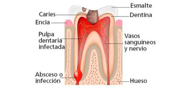 Infección de un absceso