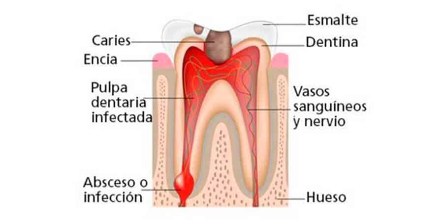 síntomas de caries rampante de diabetes