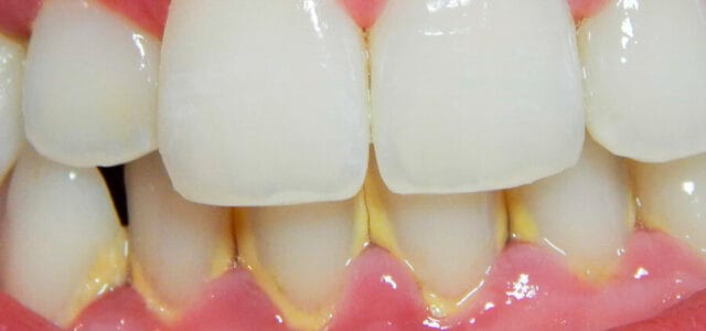 Placa dental calcificada