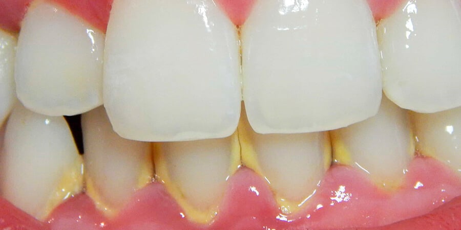 Sarro dental: ¿por qué se forma y cómo eliminarlo?】 | Ferrus&Bratos