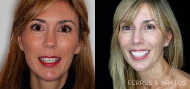 paciente adulto con dientes torcidos