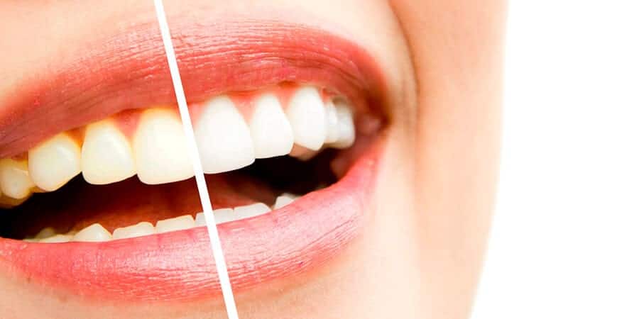 dedo cobertura puramente Blanquear los dientes con agua oxigenada ¿Es seguro?