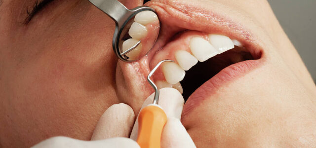 Alveolo seco Curar alveolitis seca