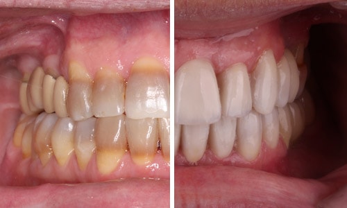 Dientes con carillas antes y despues de adelgazar