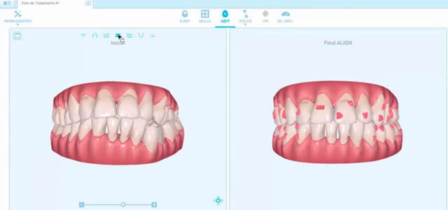 Antes y después de Invisalign