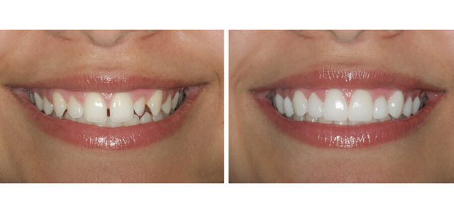 Qué carillas dentales elegir? Tipos, precios y opiniones