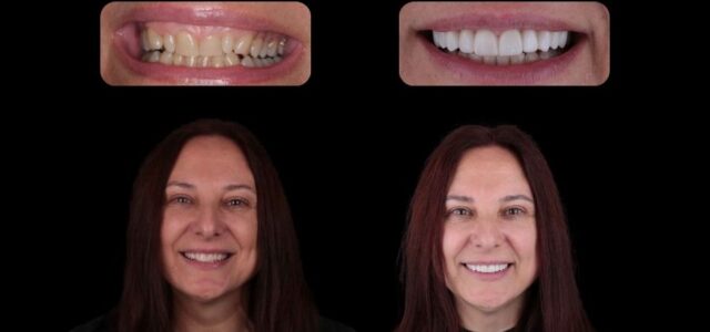 Nuestra paciente antes y después de la ortodoncia invisible La imagen de Isabel antes y después de la ortodoncia invisible