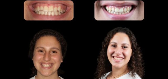 Paciente real antes y después de ortodoncia invisible Ortodoncia invisible antes y despues en Beatriz, paciente de la Clínica Dental Ferrus & Bratos