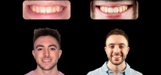 Fotos de sonrisa antes y después de la ortodoncia invisible Imagen que muestra el antes y el después de un paciente de Ferrus & Bratos con tratamiento de ortodoncia invisible