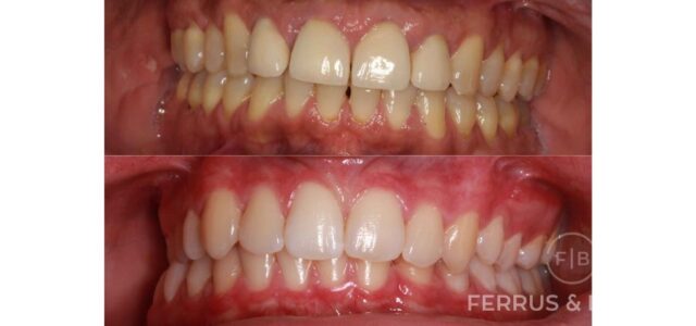 Fotos de antes y despues de piorrea