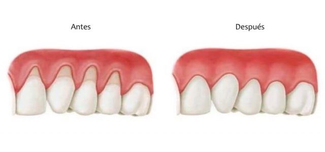 Imagen tras un injerto de encía